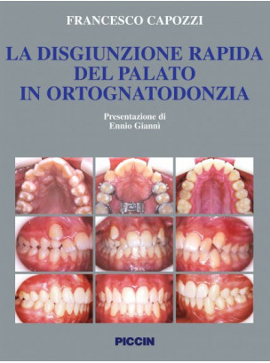 La disgiunzione rapida del palato in ortognatodonzia