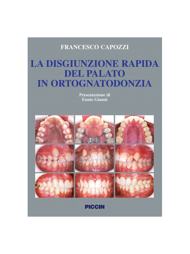 La disgiunzione rapida del palato in ortognatodonzia