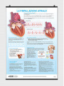 La fibrillazione atriale - per il paziente - Poster