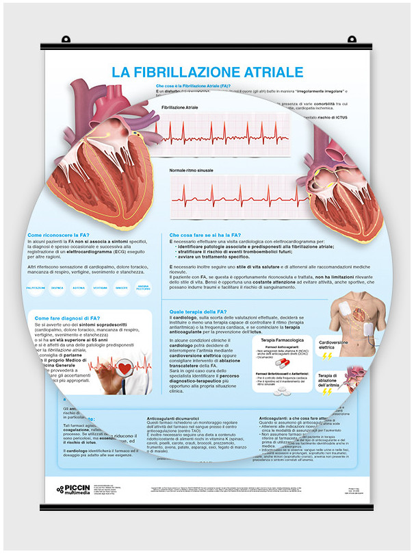 La fibrillazione atriale - per il paziente - Poster