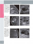 La mammella. Diagnostica per immagini