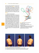 Trattamento tridimensionale della scoliosi