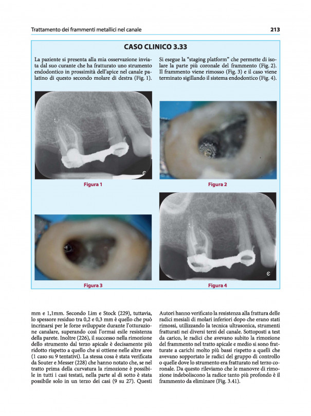 IL TRATTAMENTO DEL CASO ENDODONTICO COMPLESSO