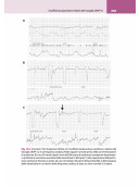 La lettura fisiopatologica della cardiotocografia intrapartum