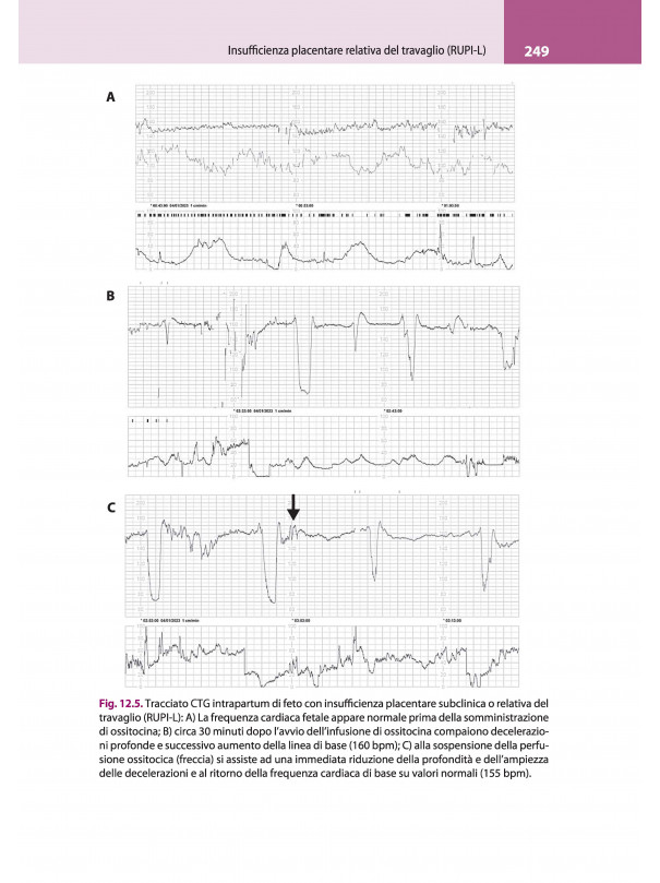 La lettura fisiopatologica della cardiotocografia intrapartum