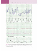 La lettura fisiopatologica della cardiotocografia intrapartum