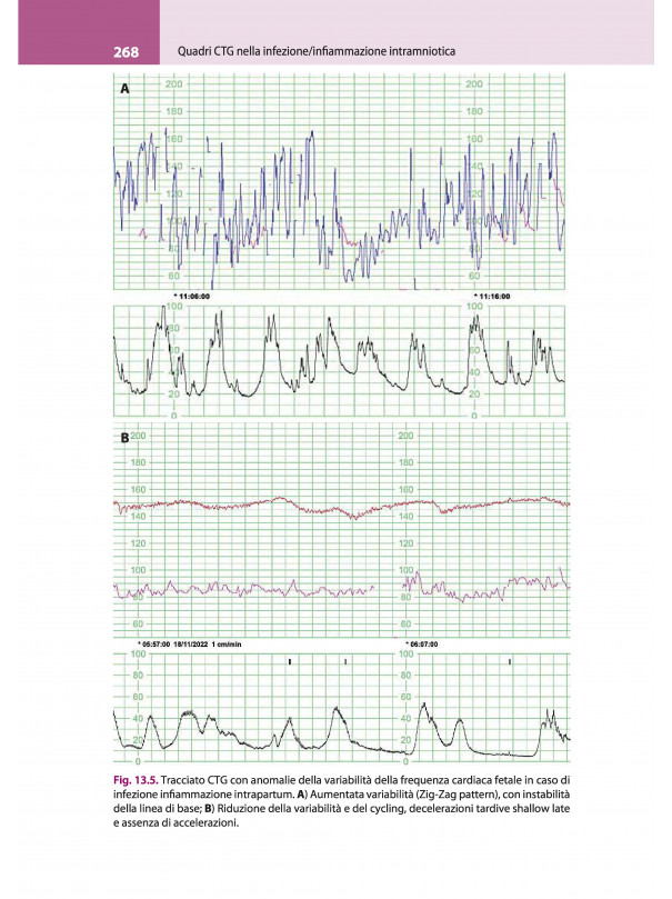 La lettura fisiopatologica della cardiotocografia intrapartum