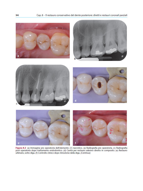 IL RESTAURO DEL DENTE TRATTATO ENDODONTICAMENTE