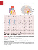 ECG