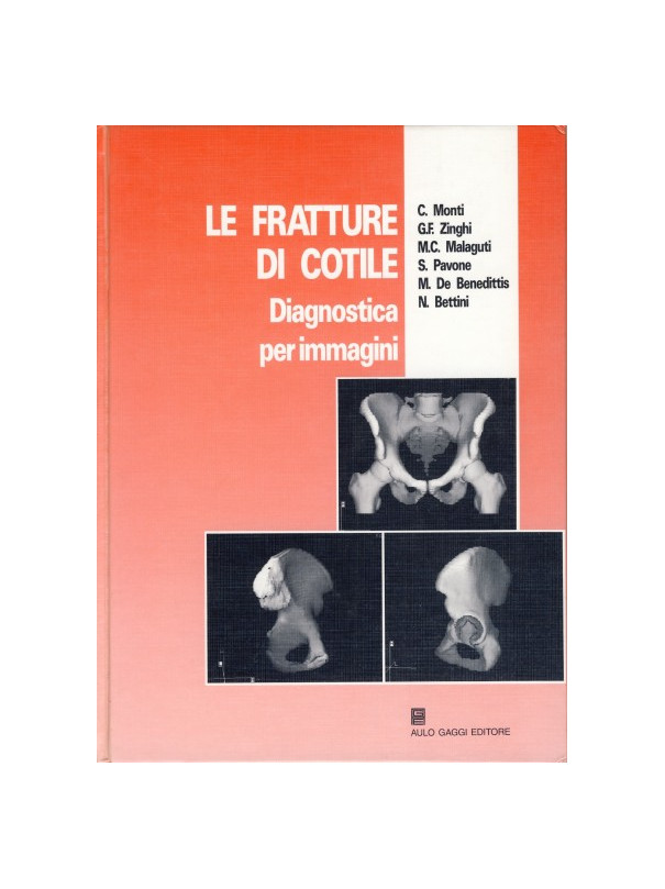 Le fratture di cotile. Diagnostica per immagini