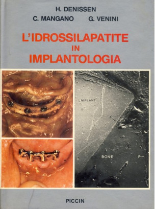 L'Idrossilapatite in Implantologia L'Idrossilapatite in Implantologia